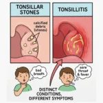 Tonsillitis vs Tonsil Stones Comparison